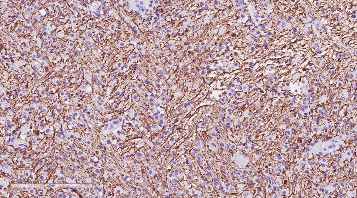 A woman in her 20s presented with an acute onset ataxia, dysarthria and weakness. Biopsy shows brain infiltrated by CD68-positive macrophages. Neurofilament reveals axons in the midst of the macrophages and LFB/PAS/Hematoxylin reveals marked loss of myelin. What is the diagnosis?