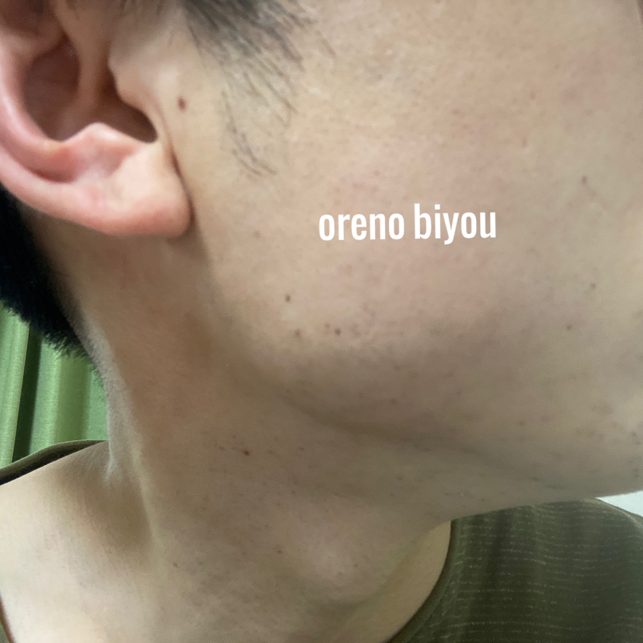 ヒゲ脱毛 経過報告写真集 Twitter