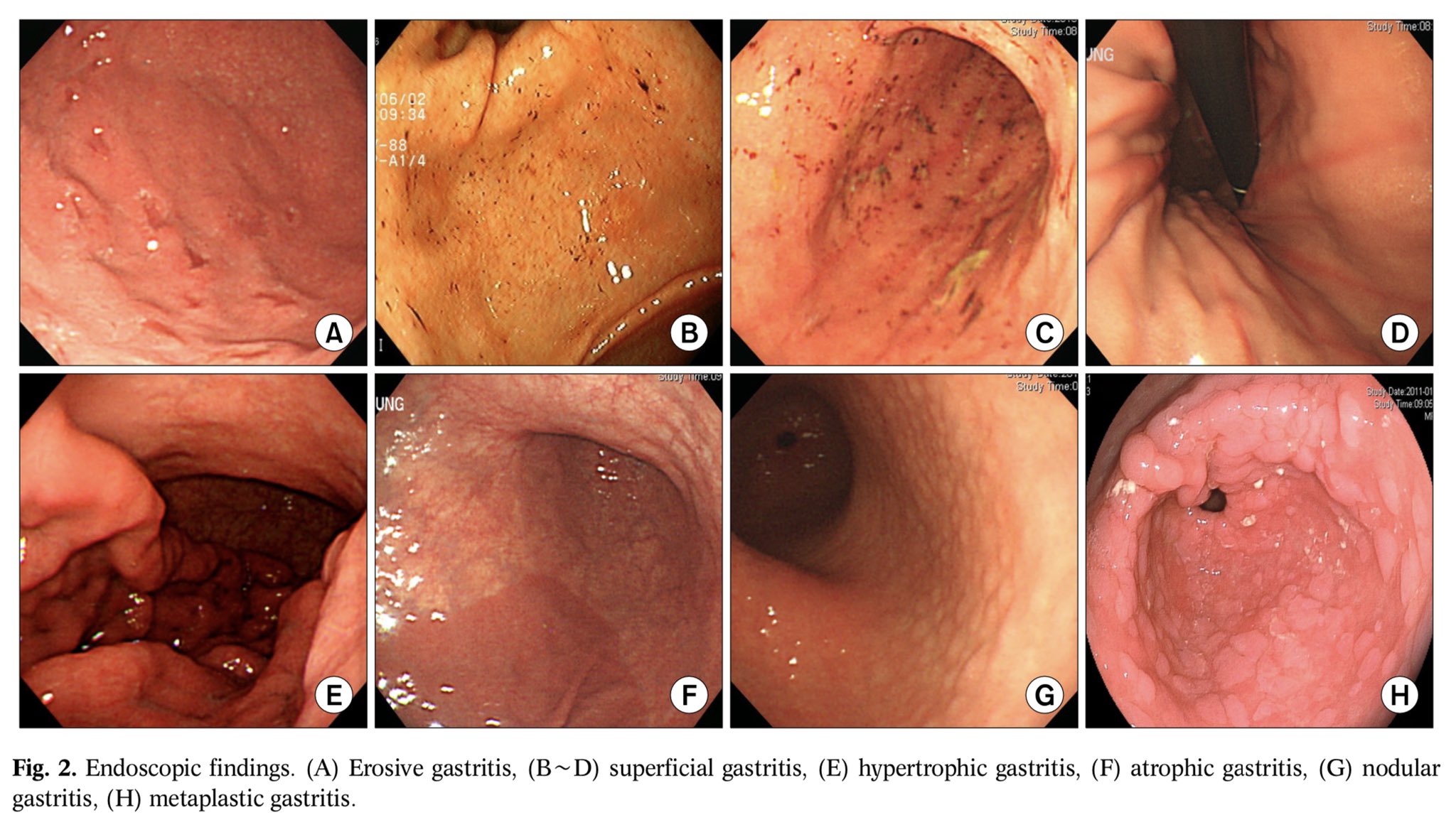 Cuanto dura una gastritis nerviosa