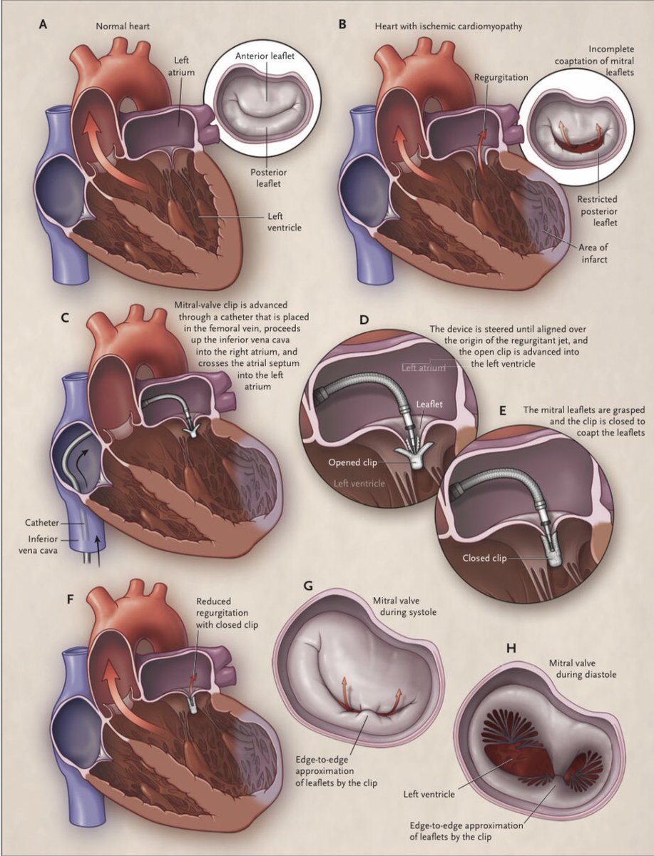 Secondary Mitral Regurgitation doi: 10.1056/NEJMcp1903331. The new england journal of medicine #cardiotwitter #cardiologia #CardioEd #Cardioweek2020 #MedEd #valves