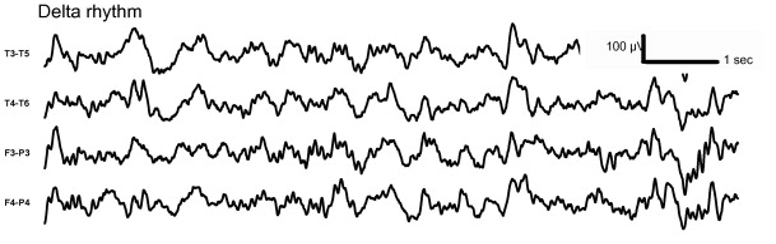 ClinicalNeuroph's tweet photo. [EEG glossary] Delta wave: Wave with duration of ¼-2 s (250–2000 ms) (https://t.co/eQBynTriVM).

Figure: https://t.co/rlxN9p1JzZ
#DeltaRhythm #EEG #ClinicalNeuroph https://t.co/9aJX90bIWl