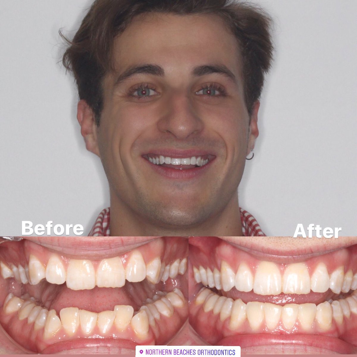 NBOrtho's tweet photo. Rocking it!  Another magnificent smile make-over achieved with Spark clear aligners. 
Our patient Aaron was thrilled with his results obtained the clear &amp; easy way. 👌🏻
#spark #sparkaligners #straighteeth  #newsmile #invisible #orthodontics #teethstraightening #beautiful #smile https://t.co/TnXwhzf6j0