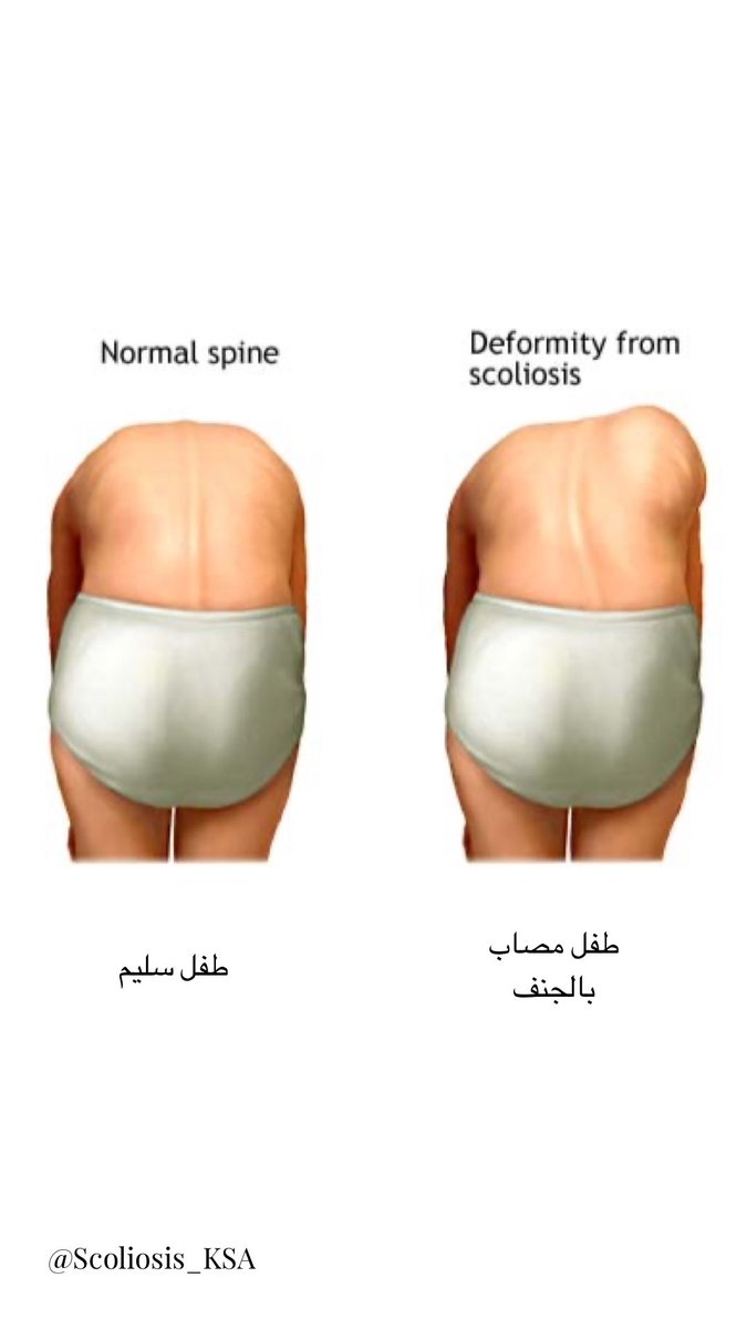 I have scoliosis (@Scoliosis_KSA) / Posts / X