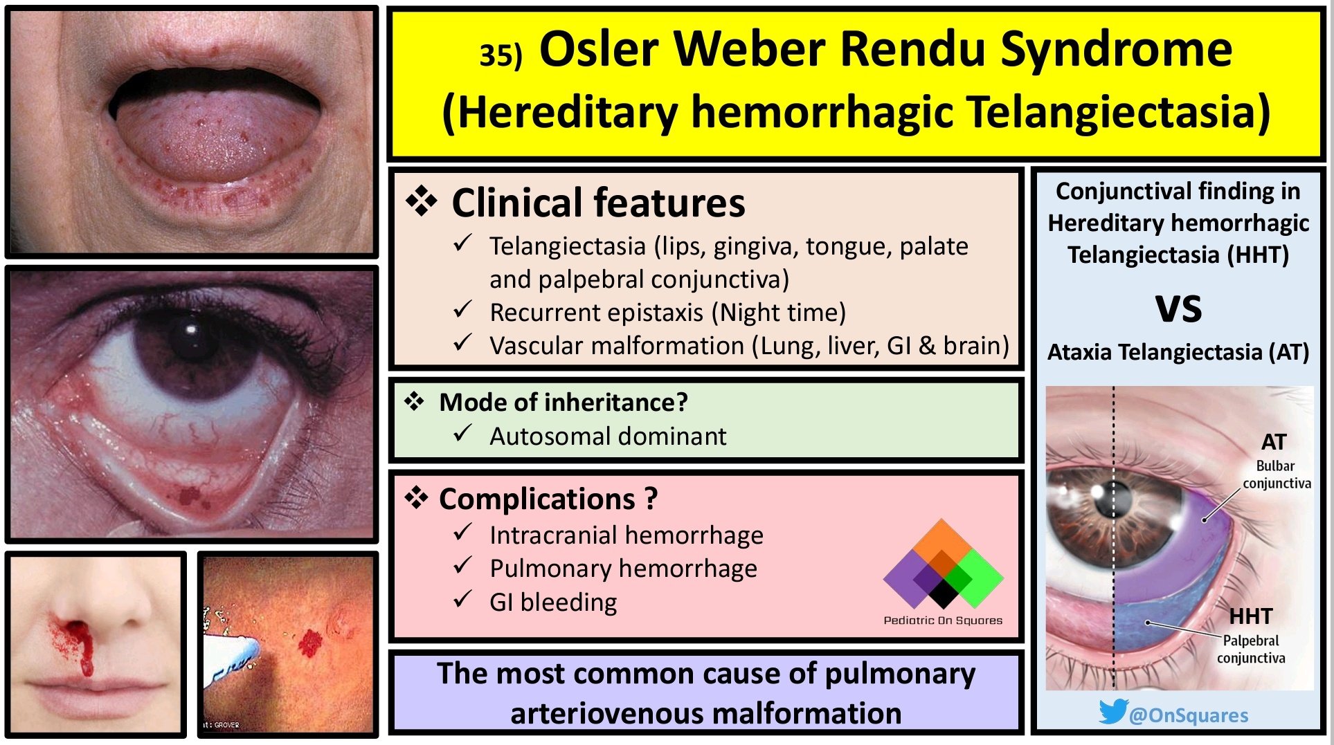 Hereditary hemorrhagic telangiectasia hht awareness - vrogue.co