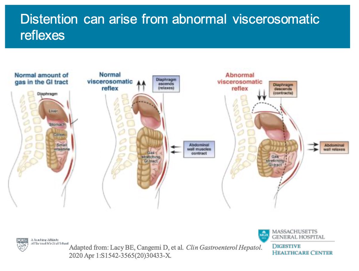 How are bloating and distention interrelated? Interesting slide from <a href="/drkylestaller/">Kyle Staller, MD, MPH</a> on how #distention is triggered from an abnormal sensation response to #bloating itself. #HarvardMotility2020