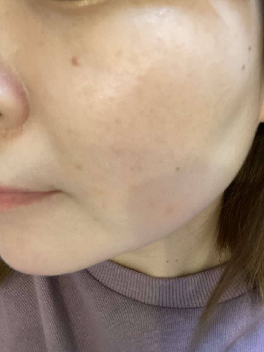 わかな はちみつ シミウス シミ隠しマジックパレットを使ってみました 濃いシミから薄いシミ まで隠せます 濃さを調節できるから使いやすい 一番濃い色だと私の肌では浮いたので 明るい色でつけてみました 結構きれいに隠れたと思います 初心者でも