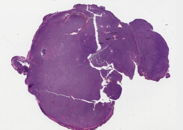 SibaElHussein's tweet photo. (5/5)
5) CD5-negative small B-cell lymphoma with plasmacytic differentiation
#Hemepath #pathtwitter #hemepathMDA #virtualHemepathMDA https://t.co/ZLb9AErKhh