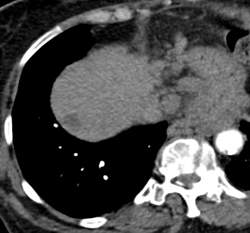 pparmetIR's tweet photo. 76 yo F w/ NASH cirrhosis, 2.7 cm dome HCC.  Atrophic liver (<600 ml), bili 1.9. Challenging location for ablation; concern for tipping liver func w/ y90 rad seg.

Opted for supraselective bland embo w/ 40 um Embozene.  No pain, same day discharge. CR at 6 week f/u CT. @SIR_ECS https://t.co/CzXIC1uZ9N