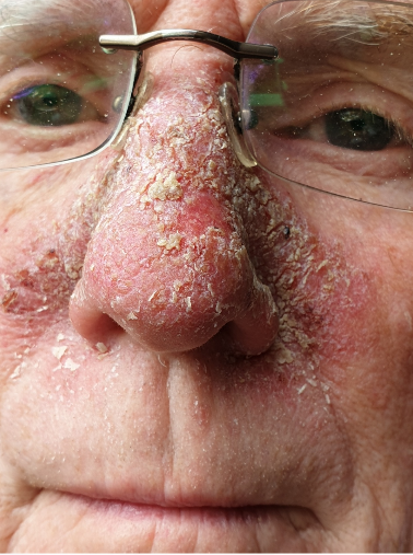 I've been attacking myself from the inside and it's all the fault of a young me who got too much sun on his nose (fixing with Efudix). https://t.co/3u1PZfFOM8