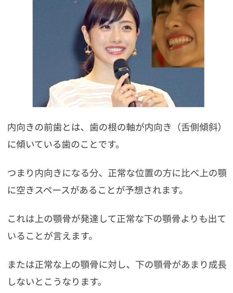 𓂃 室長さん 小動物系の可愛い人の歯並びは内向き前歯 この歯並びの顔 の特徴 上顎が発達して下顎より出る 下顎があまり成長してない 上顎が前方に出て顎が小さいから童顔で若く見える 石原さとみも宇垣アナもそうだよね 歯科的におすすめしないけど