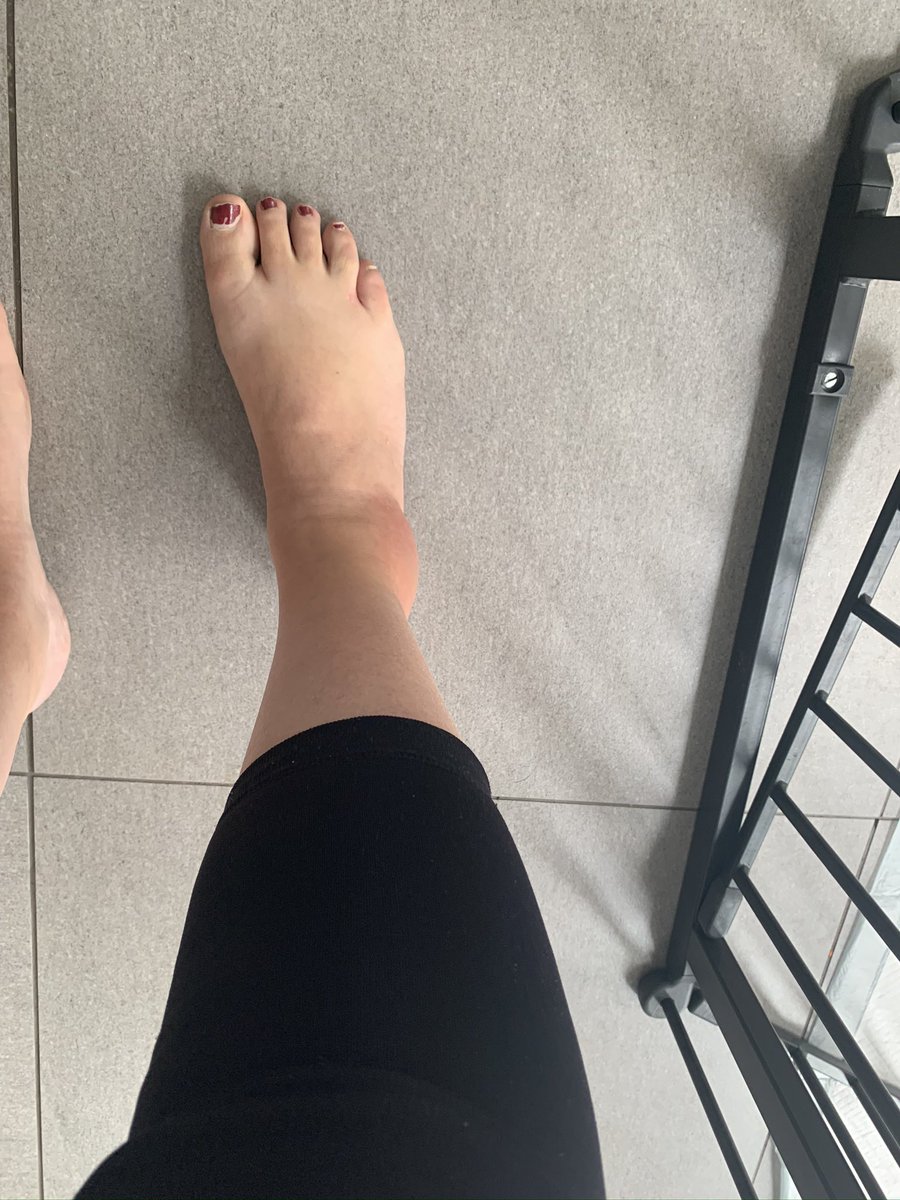 Annabel74970348's tweet photo. Thank you to the lovely staff at Newark Urgent Care for looking after me so swiftly and safely yesterday @sfhft #newarkurgentcare #sherwoodforesthospitals #itsnotbroken #itsjustasprain #2020doone https://t.co/ESbIc01qPe