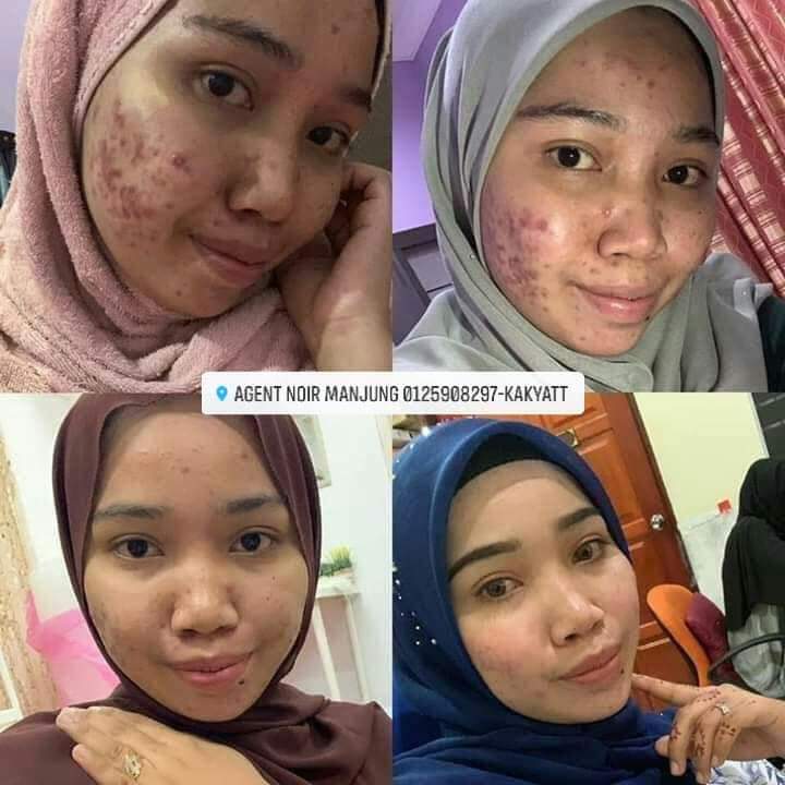 noir skincare testimoni