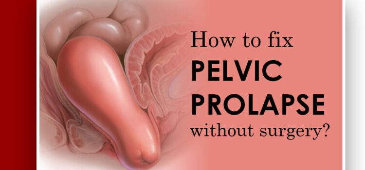 How to Fix a Prolapse Without Surgery 
