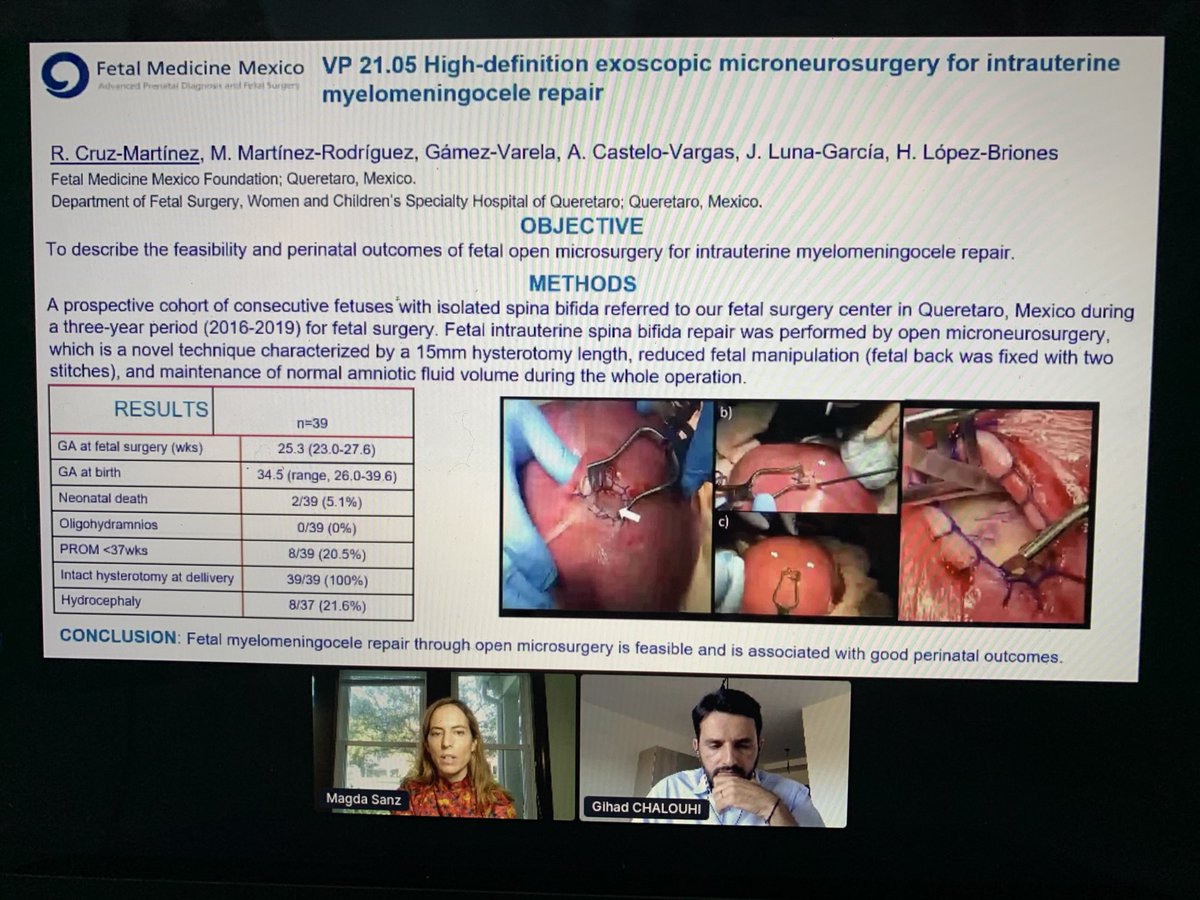 lucastrigo's tweet photo. Some very interesting data was just presented in Hub2 regarding #spinabifida prenatal repair, from @LapaDenise, Rogelio Cruz-Martinez, and Romain Corroenne. Thank you for the clear presentation, @masancor07! #ISUOG2020 @ISUOG https://t.co/5PKFFZ0hxP