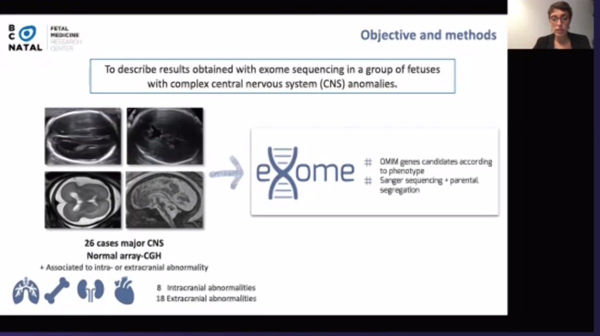 ISUOG's tweet photo. Elisenda Eixarch (@elisendaeixarch) presenting on use of exome sequencing in fetuses with complex central nervous system anomalies at #ISUOG2020 session on Use of exome sequencing in fetuses with complex central nervous system anomalies. https://t.co/osJqnCyjTE