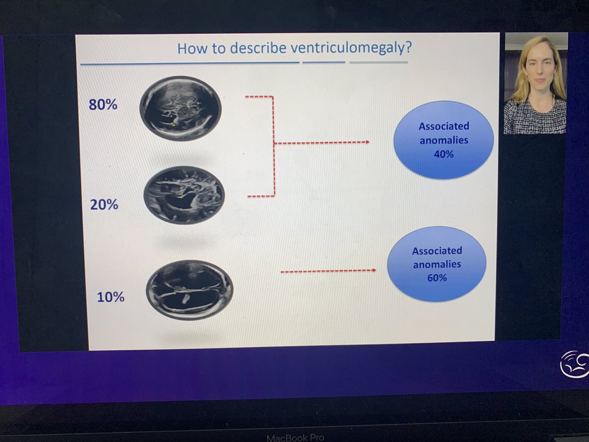 lucastrigo's tweet photo. Outstanding presentation from @masancor07 regarding ventriculomegaly. Thank you for such amazing masterclass! @ISUOG #isuog2020 #fetalmedicine #ventriculomegaly https://t.co/bdPUQ80RoS