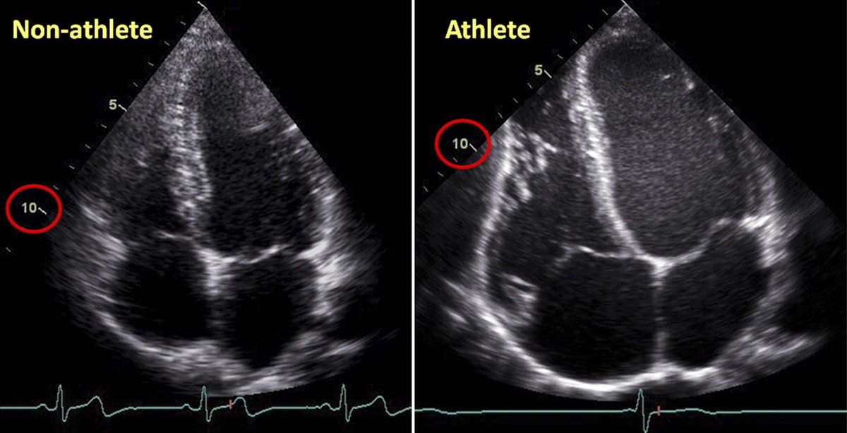 TachyTrep's tweet photo. 4 chamber view comparison showing increased LV mass, LA size and RV cavity with bradycardia as seen in many athletes on the right   #echofirst #ase360 #cardiotwitter #foamus #foamed @sono_sam @Bicuspid_Babe @dont_be_tachy @Ultra_Brock @Cardi_AC @clipsoftheheart https://t.co/Y5OQvq98Dg