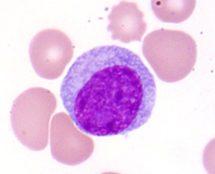 judith_ferry's tweet photo. Pathologists! Check out this case. Patient has history of plasma cell myeloma, now with elevated WBC. By flow, 40% of cells are clonal plasma cells (>6000 cells/microL), thus fulfilling criteria for plasma cell leukemia. #hemepath https://t.co/CPuUNrboqL