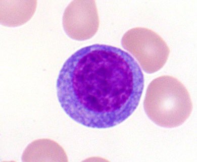 judith_ferry's tweet photo. Pathologists! Check out this case. Patient has history of plasma cell myeloma, now with elevated WBC. By flow, 40% of cells are clonal plasma cells (>6000 cells/microL), thus fulfilling criteria for plasma cell leukemia. #hemepath https://t.co/CPuUNrboqL