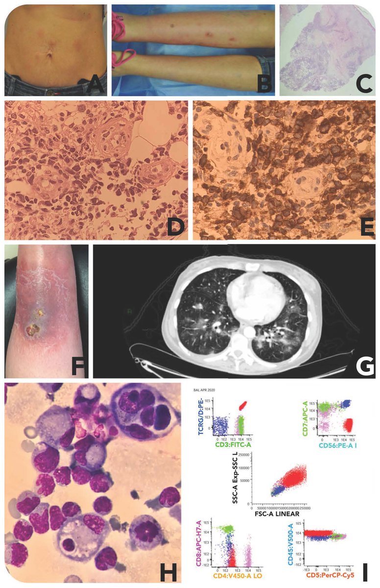 Primary cutaneous γδ T-cell lymphoma with secondary lung involvement ow.ly/WjZg50BUTGB