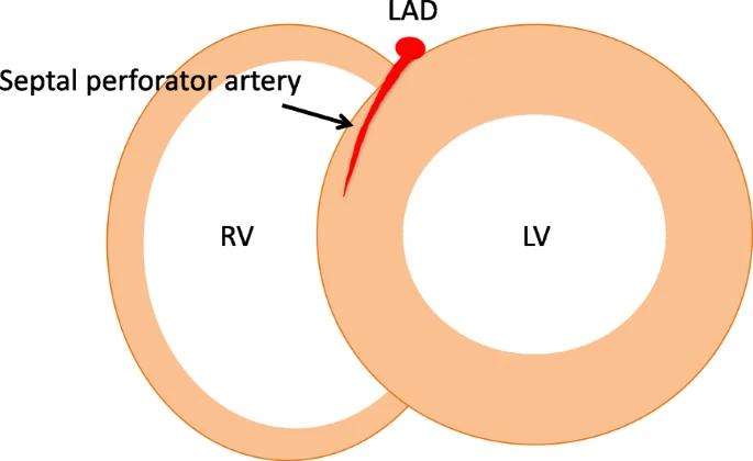 VLSorrellImages's tweet photo. Learn through Twitter: did everyone already know this?
I admit it - I did not!

Basal IVS LGE may reflect septal perforator (not to be confused with DCM midwall fibrosis):
https://t.co/v1bC7erGhv 

@Heart_SCCT 
@SCMRorg https://t.co/WxnTTXnhCC