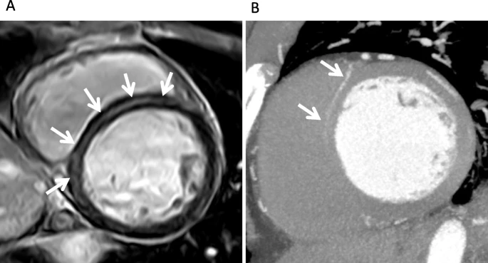 VLSorrellImages's tweet photo. Learn through Twitter: did everyone already know this?
I admit it - I did not!

Basal IVS LGE may reflect septal perforator (not to be confused with DCM midwall fibrosis):
https://t.co/v1bC7erGhv 

@Heart_SCCT 
@SCMRorg https://t.co/WxnTTXnhCC