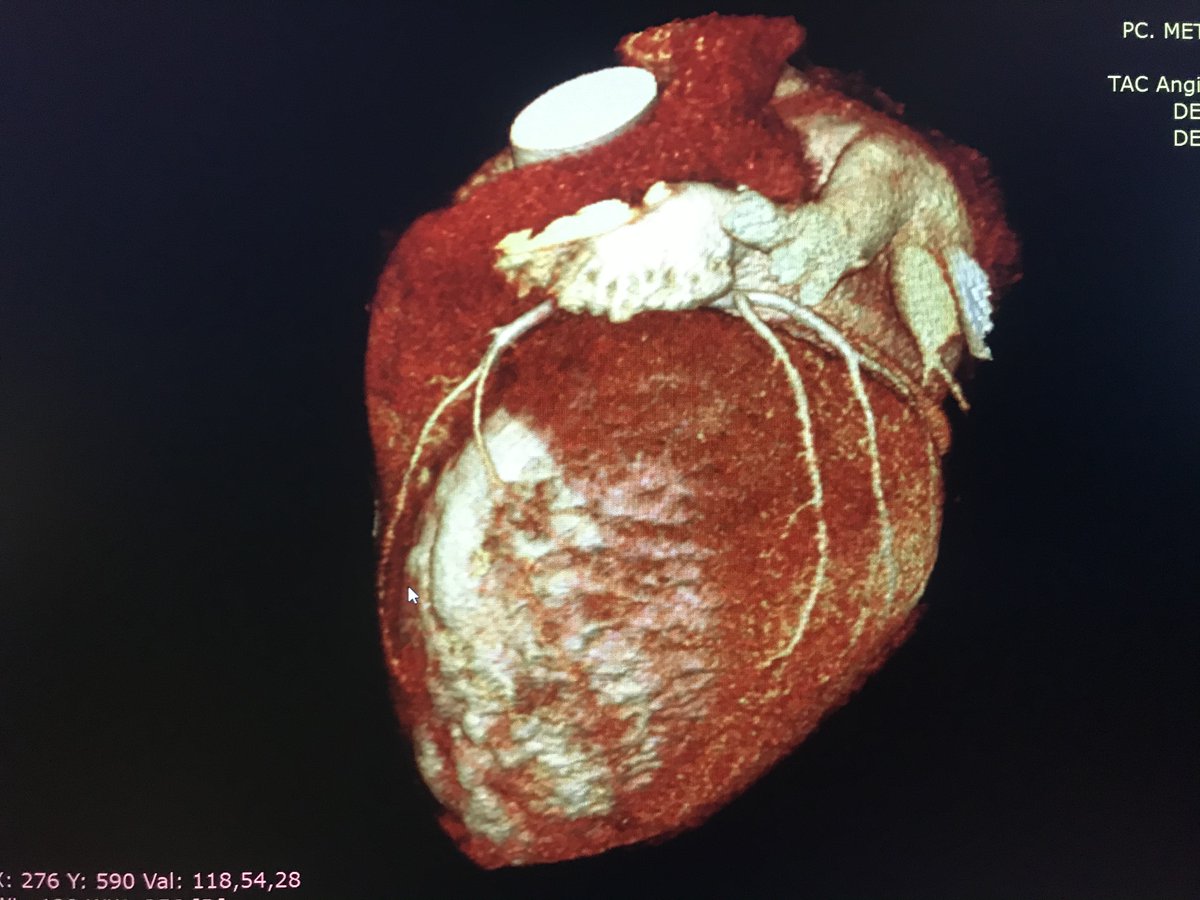 ecardioimage's tweet photo. Próximamente disfrutarás del mejor Curso de Cardio-TC en #ecardioimage⏳🤓
#YesCCT #elearning #ideas
@SAC_54 @sac_hit @EGarciaSayan @GARCIAEDINSON95 @almasthela @mariovar55 @wikimagen @gusavegliano @onco_cardiology @iamritu @drEdgarFuentes @filikinetico @DiegoChangomd https://t.co/6jbpg8MkVY