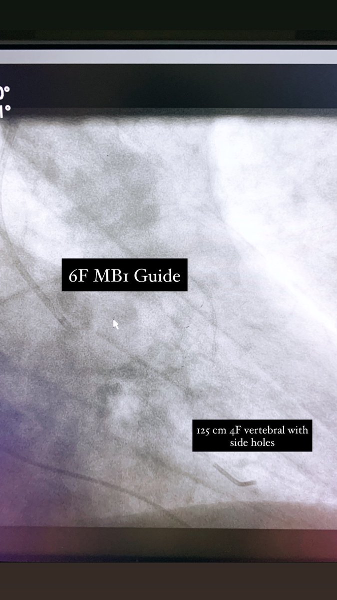 DrJayMohan's tweet image. Severe AS by TEE (MG 60 mmHg). INR 1.9. Wasn’t planning on crossing the valve but JR popped across (luck). We don’t have 4F PIG. In age of no Langston made due with what I had! Right radial 6F MB1 guide with mother daughter 4F vert. MG on cath 52 mmHg. #CathLabHack #Cardiotwitter