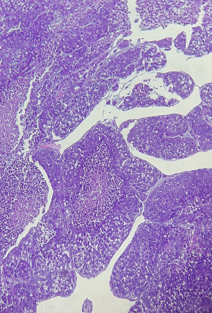 drsofa's tweet photo. Need your opinion #pathologist
Parotid tumor, 74 years old lady. No prior surgery / history.
Thank you 👨🏾‍⚕️
#headandneck #pathology 
@AbhijitSurgPath @Sara_Jiang @GeronimoJrLapac https://t.co/BR3biVI9Ci