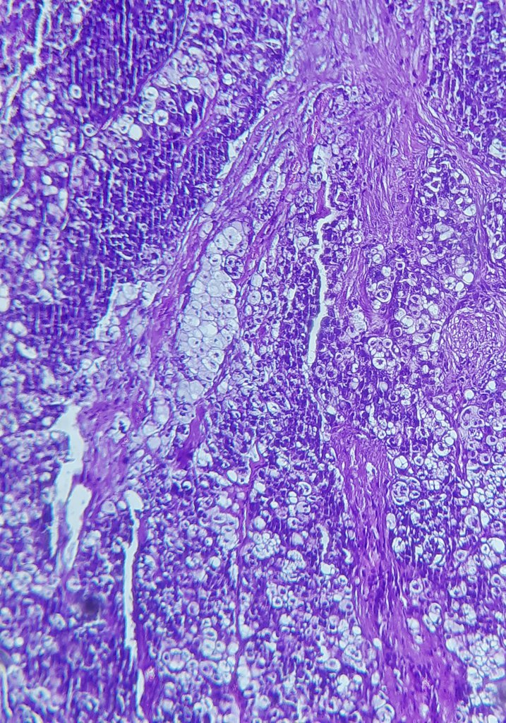 drsofa's tweet photo. Need your opinion #pathologist
Parotid tumor, 74 years old lady. No prior surgery / history.
Thank you 👨🏾‍⚕️
#headandneck #pathology 
@AbhijitSurgPath @Sara_Jiang @GeronimoJrLapac https://t.co/BR3biVI9Ci
