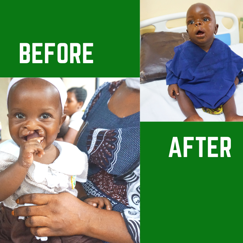 CCBRTTanzania's tweet image. CCBRT performs half of all cleft lip/palate surgeries in Tanzania. After COVID-19 pandemic relief  we have performed over 250.