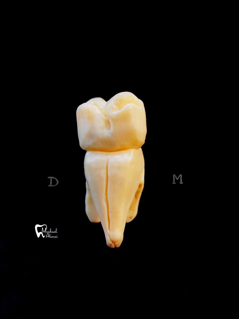Dr_Alsousi's tweet photo. @aboutDent @Dientes_ksa Maxillary 1st molar 🦷 #عن_طب_الأسنان https://t.co/6DBrZgqB8v