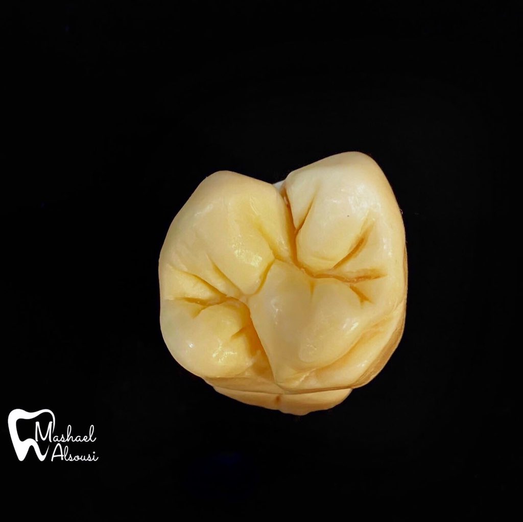 Dr_Alsousi's tweet photo. @aboutDent @Dientes_ksa Maxillary 1st molar 🦷 #عن_طب_الأسنان https://t.co/6DBrZgqB8v