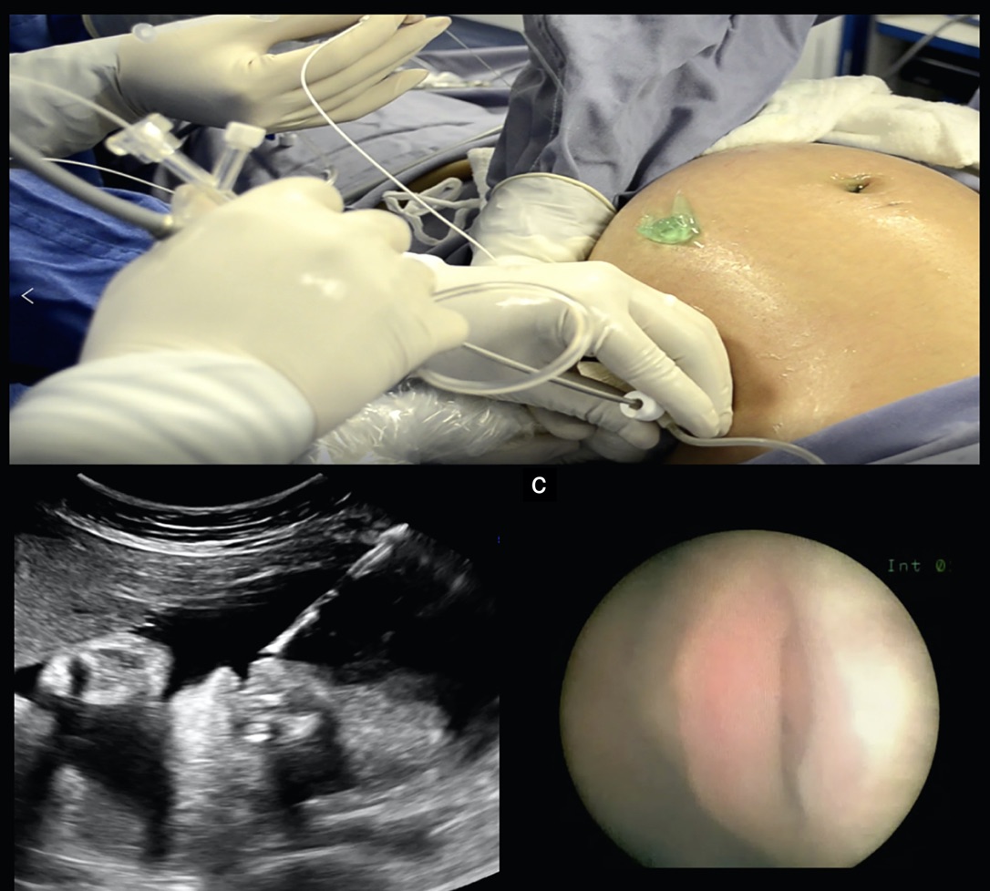Does fetal endoscopic tracheal occlusion have a role in the management of left-sided congenital diaphragmatic hernia in low-resource countries? Find out in a new #UOGJournal article #ISUOG https://t.co/lpv8f4AtOE https://t.co/0eccQ7TnJd
