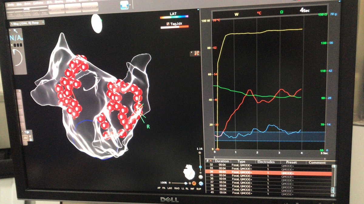 JoseMGuerraR's tweet photo. First case in #Spain of #afib ablation with High Power Short Duration with #qdotmicro in @HospitalSantPau @BiosenseWebster. https://t.co/4QR9pnt4PX