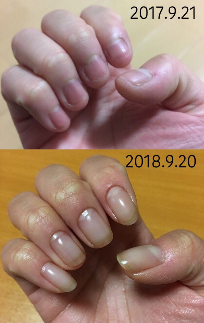 諦めない 爪をケアするようになって1年 ビフォーアフターが凄い ライフハックの域 爪の形変えられるの初めて知った Togetter