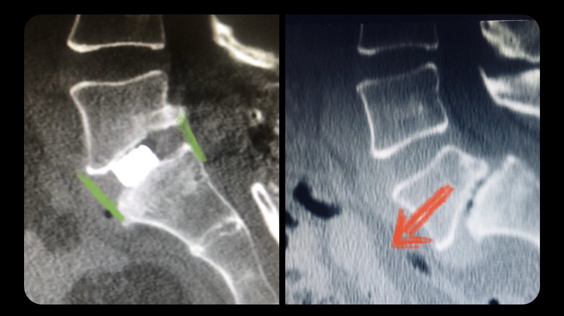 Dr_Faizo's tweet photo. Pre-and post op #spinal 
L5-S1 #spondylolisthesis #fixation https://t.co/KJiIMxIzVT