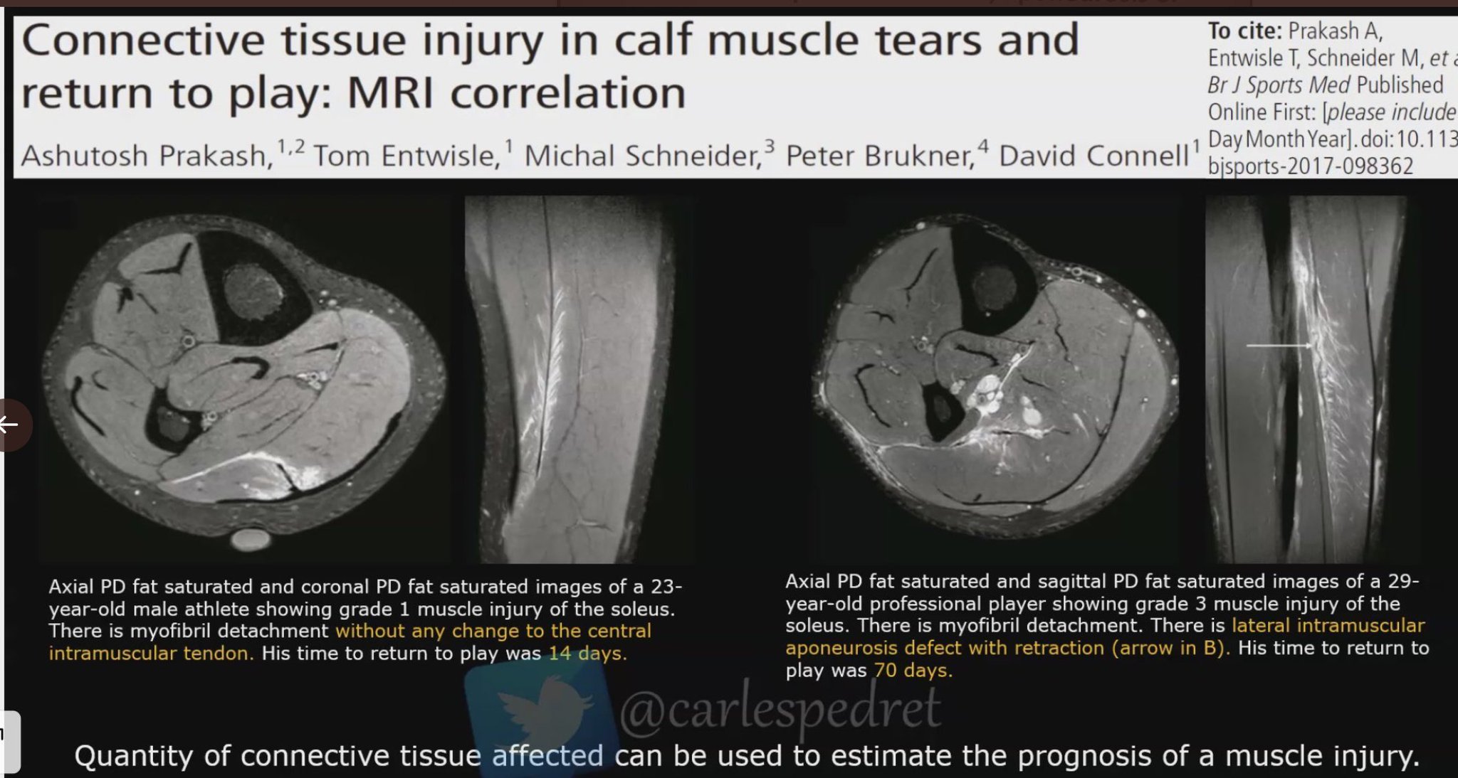 Lorenzo Masci on Twitter "6. Soleus injuries usually insidious