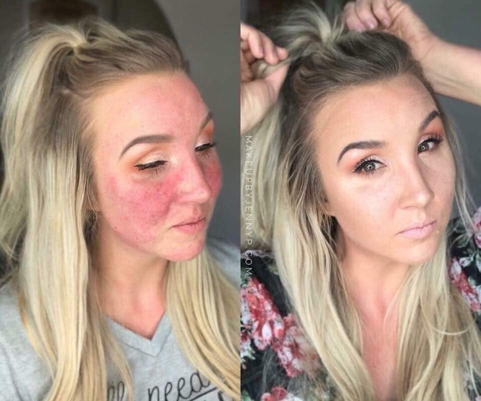 This is Jenny using the stick foundation, she struggles with Rosacea, but look how well it covers! Takes just 2mins 2 apply! Just comment with a 💓 &amp; my friend Linda will contact you to offer you a free colour match and advise regarding what will be the perfect product for you.