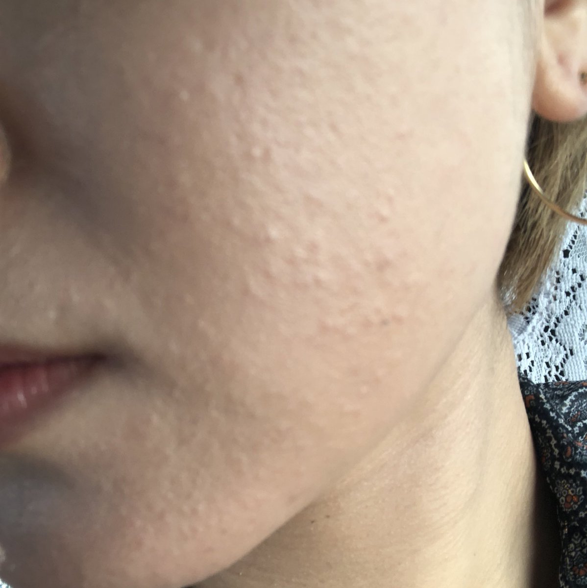 チャクラ全開チャン 閲覧注意だけど こんな状況 昨日よりはだいぶ引いた とりあえず皮膚科は夕方に予約した そしてdプログラムも買いました 使用感わかったらまたまとめます 花粉皮膚炎 花粉症 チャクラ全開チャン 閲覧注意だけど こんな状況 昨日よりはだいぶ引いた とりあえず皮膚科は夕方に予約した そしてdプログラムも買いました 使用感わかったらまたまとめます 花粉皮膚炎 花粉症