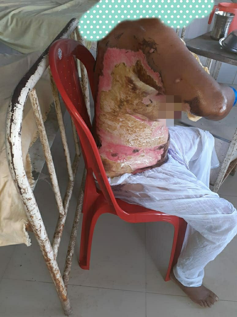 HelpingHandsTwt's tweet photo. Fundraiser alert:🚨
Raising funds for a 3rd degree burn patient, Amana from Gaya, Bihar, who is unable to bear the expenses of her treatment.

Target Amount- 3lacs
Gpay/phonpe/paytm- 9490400871

Pls DM for further details or contact +91 79039 02436. https://t.co/ybsbSLYPBB