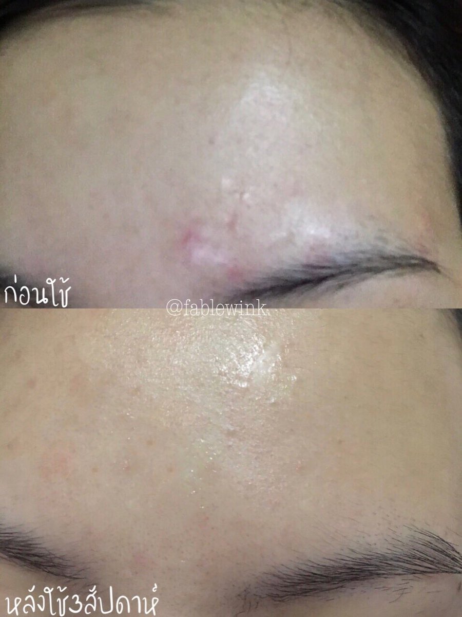 เห็นคนตามหา <a href="/SkinsistaTH/">Skinsista Official</a> แบบซองใน 7-11 กันเยอะ เลยซื้อมาใช้ ไม่แปลกใจ ว่าทำไมขายดี!! ซองนี้คือ2in1 รวมบูสเตอร์ครีม สะดวกดี ใช้ซองเดียวจบ เราใช้สูตรสีส้ม ที่เน้นลดจัดการทุกปัญหาสิว รวมถึงคุมมัน ที่เห็นชัดๆคือรอยแดงจากสิวจางลงไปมากก สิวผดยุบแห้งลง ประทับใจ #รีวิวเซเว่น #ใช้ดีบอกต่อ