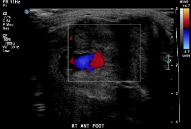 #FOAMed Case: annemergmed.com/article/S0196-…

• 30 y/o male with swelling and pain in his right foot
• Two months before, PT experienced blunt trauma to the dorsum of his foot when he accidentally kicked a statue