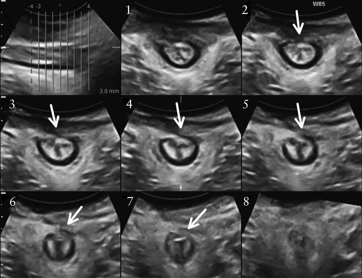 How comparable is the clinical grading of obstetric anal sphincter injury with that determined by four-dimensional translabial ultrasound? Find out in the new #UOGJournal article by Gillor and Colleagues #ISUOG https://t.co/roSlLEKDtc #LoveUltrasound https://t.co/5QmpIehXfP