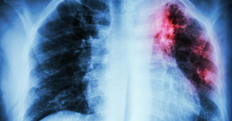 NPRCnews's tweet photo. Latent #tuberculosis can become active and infectious without warning, which is why researchers at @yerkesnews and @txbiomed #SNPRC are collaborating to develop better treatments. They discovered a specific combination of antibiotics could help.