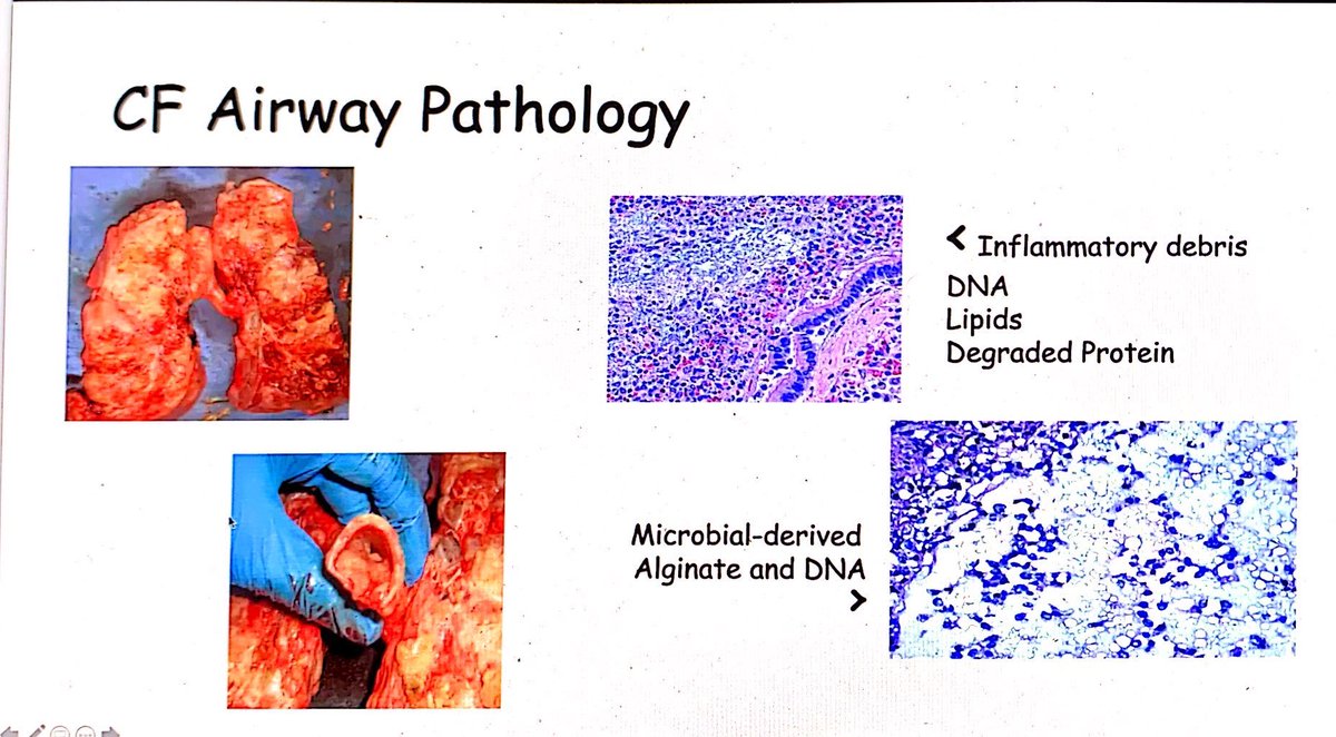 CF airway pathology includes inflammatory debris (DNA, lipids, degraded protein).  #CHEST2020