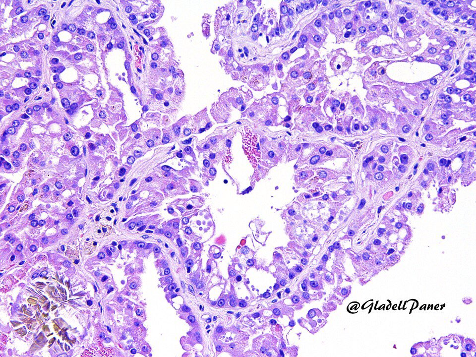 The most consistent histology for Acquired Cystic Disease-Associated Renal Cell Carcinoma - Intra/intercellular spaces, & if florid impart a sieve-like/microcystic pattern. Note calcium oxalate crystals; common but not always present. #GUPath