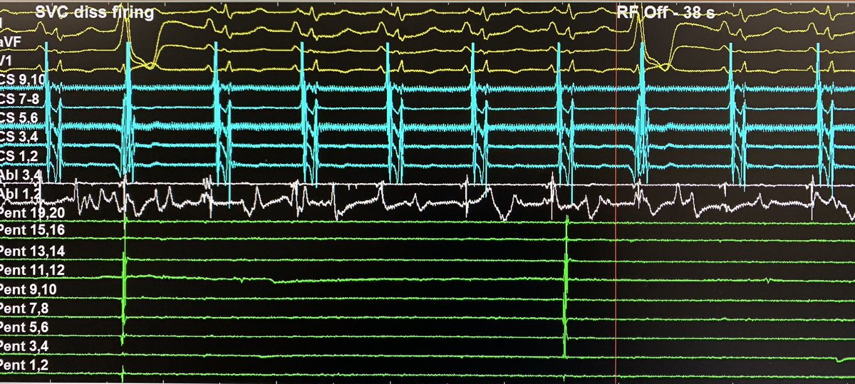 Redo redo redo PAF. Left PVs reconnected and SVC connected. Large SVC isolated with dissociated firing post-isolation #epeeps  #cardiology  #afablation