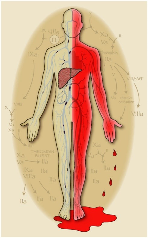 Pennsylvania Society of Gastroenterology (PSG) (@pagastrosoc) on Twitter photo High yield #Tweetorial on coagulopathy of liver disease. Prone to bleed? Prone to clot? #livertwitter #medtwitter
Check out ncbi.nlm.nih.gov/pmc/articles/P… for historical perspective.
Content provided by: <a href="/VivianOrtizMD/">Vivian Ortiz</a>
Thread 1/7
#PAGastro #LiverDiseaseAwareness High yield #Tweetorial on coagulopathy of liver disease. Prone to bleed? Prone to clot? #livertwitter #medtwitter
Check out ncbi.nlm.nih.gov/pmc/articles/P… for historical perspective.
Content provided by: <a href="/VivianOrtizMD/">Vivian Ortiz</a>
Thread 1/7
#PAGastro #LiverDiseaseAwareness