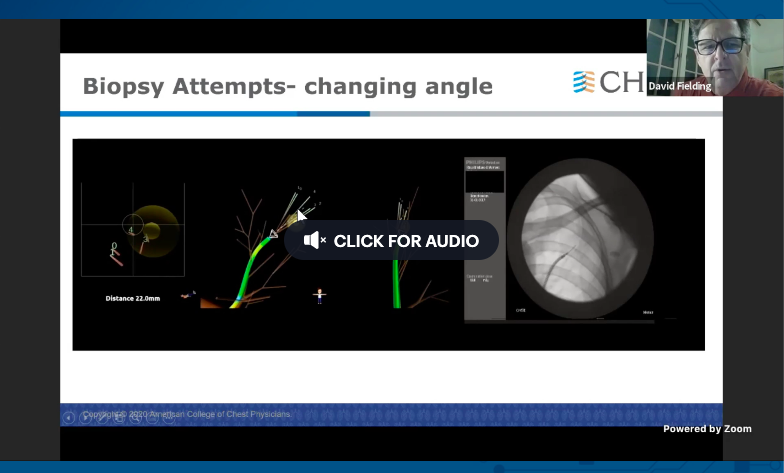 ahalraiyes's tweet photo. #CHEST2020 Procedures - Controversies in Diagnostic and Therapeutic #Bronchoscopy A Pro-Con Debate
@accpchest @CHESTOncology #CHESTon https://t.co/Kc9ScyJaBv